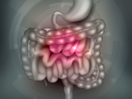 ileocecal valve syndrome