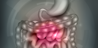 ileocecal valve syndrome