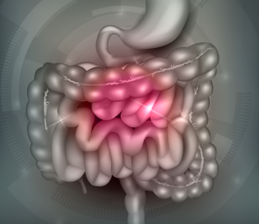 ileocecal valve syndrome