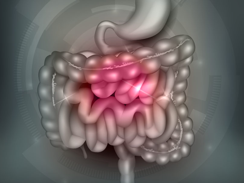 ileocecal valve syndrome