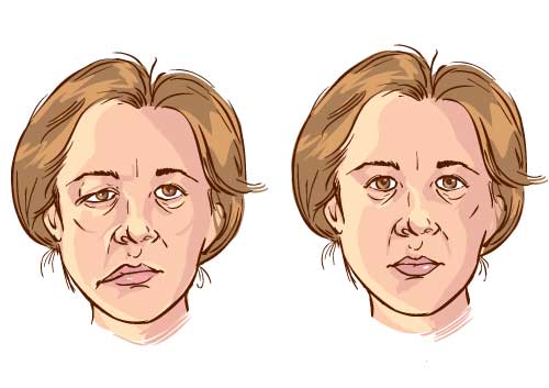 bells palsy drawing